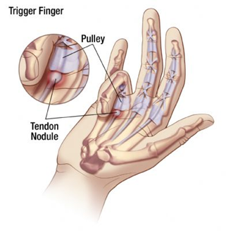 Trigger Finger/ Trigger Thumb