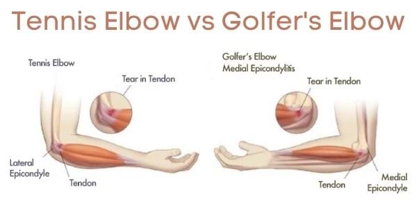 Tennis Elbow and Golfers Elbow